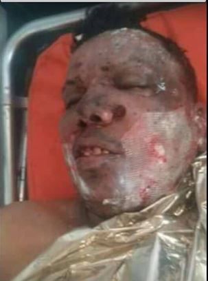 إصابة المصور "العبيدي" بصاروخ حراري أطلقته المليشيا خلال تغطيته سير المعارك غربي تعز